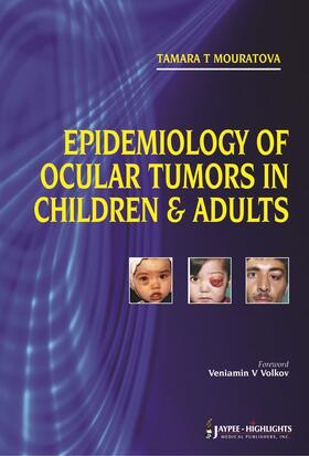 Mouratova |  Epidemiology of Ocular Tumors in Children & Adults | Buch |  Sack Fachmedien