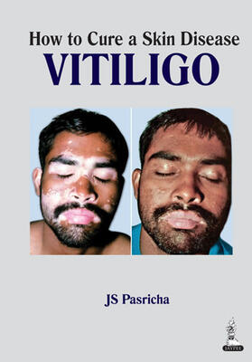 Pasricha |  How to Cure a Skin Disease: Vitiligo | Buch |  Sack Fachmedien