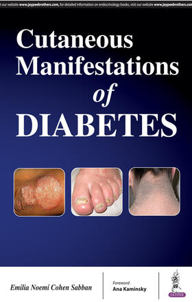 Emilia / Cohen Sabban |  Cutaneous Manifestations of Diabetes | Buch |  Sack Fachmedien