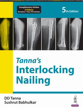Tanna / Babhulkar |  Tanna’s Interlocking Nailing | Buch |  Sack Fachmedien