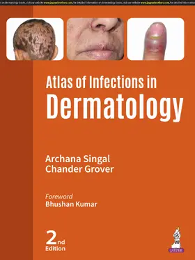 Singal / Grover |  Atlas of Infections in Dermatology | Buch |  Sack Fachmedien