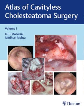 Morwani / Mehta |  Atlas of Cavityless Cholesteatoma Surgery, Vol 1 | Buch |  Sack Fachmedien