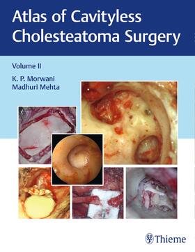 Morwani / Mehta |  Atlas of Cavityless Cholesteatoma Surgery, Vol 2 | Buch |  Sack Fachmedien
