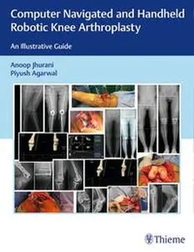 Jhurani / Agarwal |  Computer Navigated and Handheld Robotic Knee Arthroplasty | eBook | Sack Fachmedien