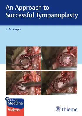 Gupta |  An Approach to Successful Tympanoplasty | Buch |  Sack Fachmedien